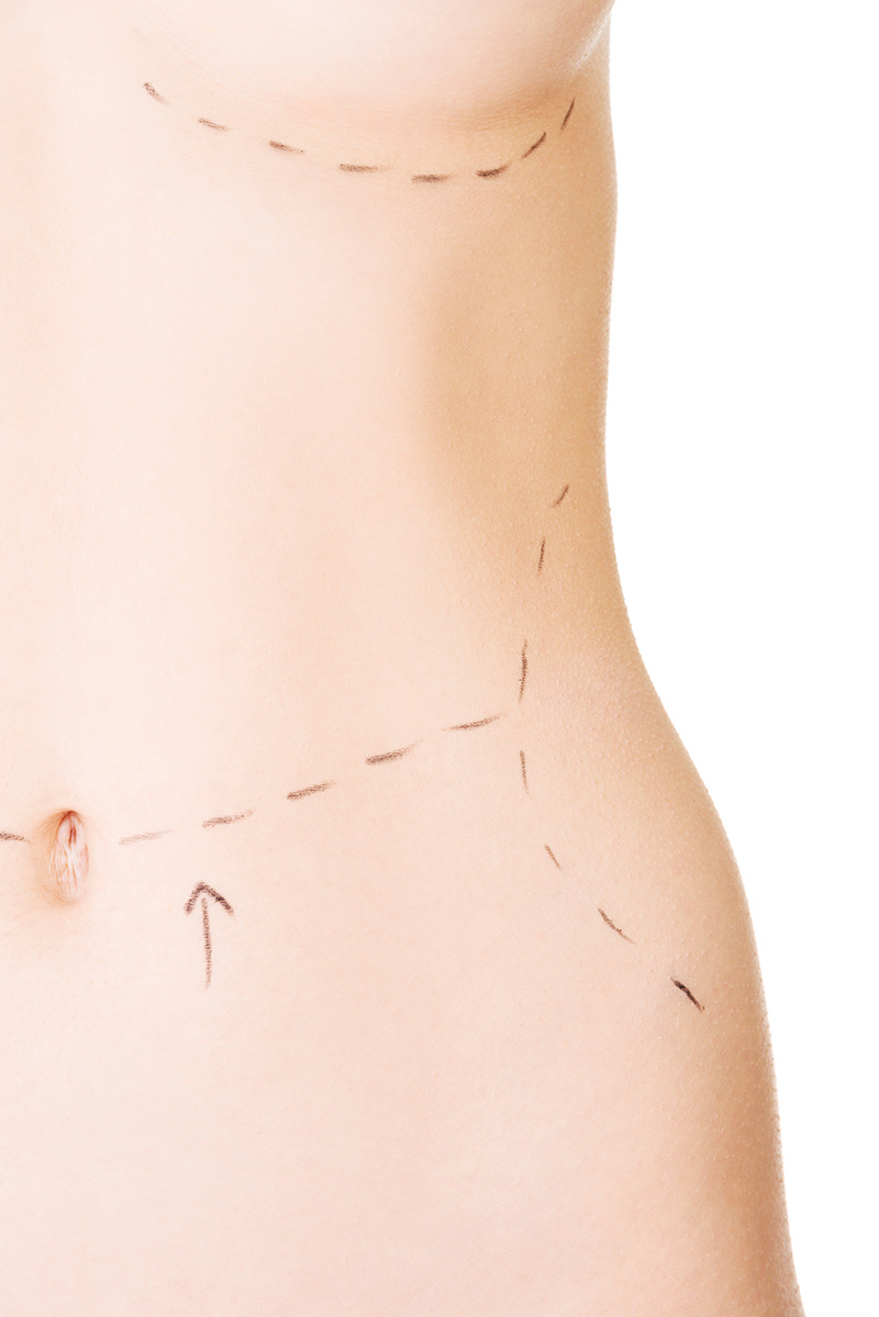 liposuction yagalma